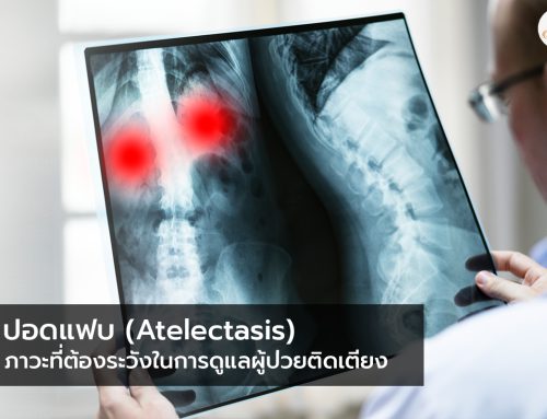 ปอดแฟบ (Atelectasis) – ภาวะที่ต้องระวังในการดูแลผู้ป่วยติดเตียง